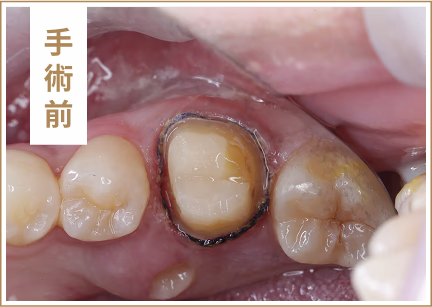 案例一術前 牙周治療案例1術前