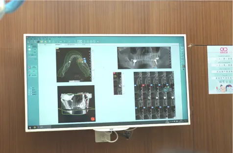 補牙特別優惠 補牙特別優惠物料展示