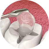 常規樹脂充填 常規樹脂充填 深圳愛康健補牙