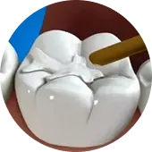超強納米樹脂充填 超強納米樹脂充填 深圳愛康健補牙