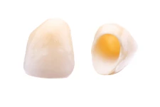 固定式假牙：全瓷及全鋯牙套示意圖